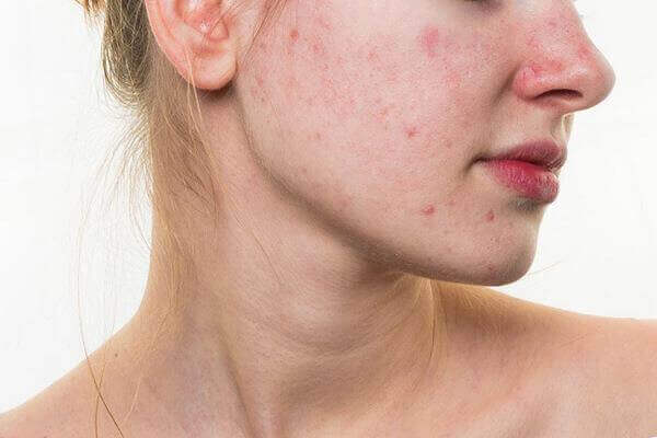 Da nhiễm corticoid là gì