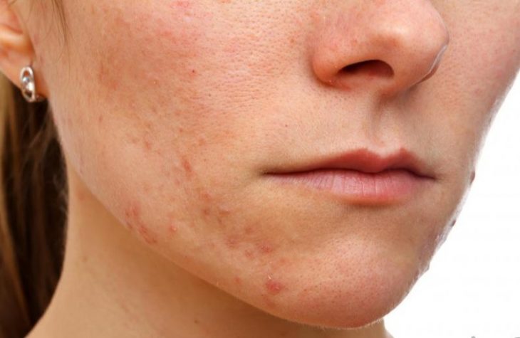 Dấu hiệu da nhiễm corticoid