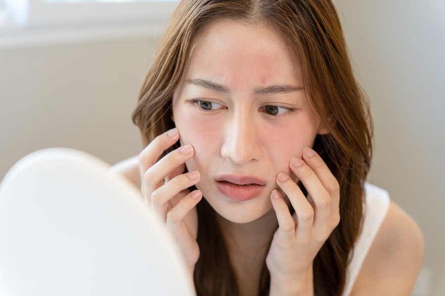 Peel da bị đỏ rát phải làm sao