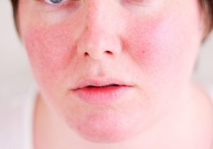 Tại sao sau khi peel da bị đỏ rát?