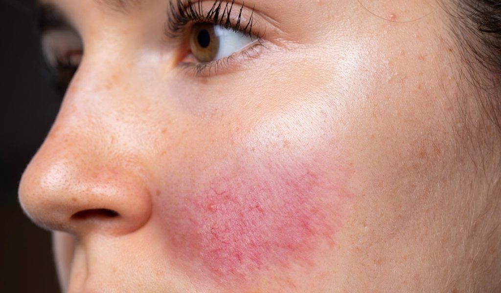 Da bị kích ứng là gì