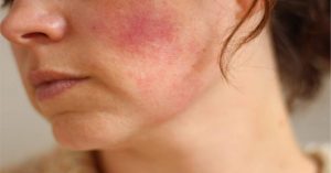 Da bị kích ứng mẩn đỏ bao lâu thì hết