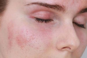 Dấu hiệu nhận biết da bị kích ứng mẩn đỏ