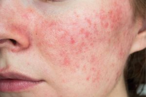 Khó khăn khi điều trị da kích ứng?