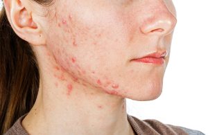Kích ứng da mặt là gì