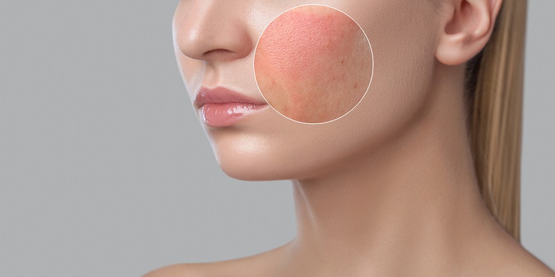 Làm gì khi da bị kích ứng?