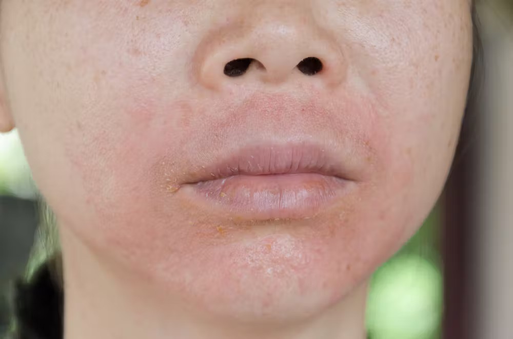 Da kích ứng mỹ phẩm bao lâu thì hết?