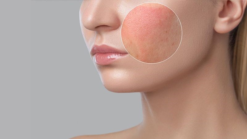 Dấu hiệu nhận biết da kích ứng mỹ phẩm