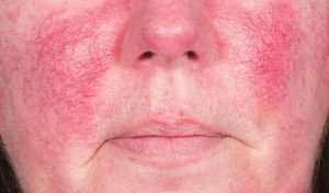 Da bị nhiễm corticoid 